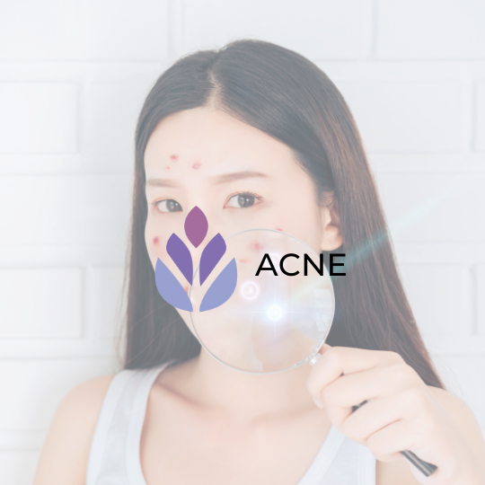 Tratamento para Acne