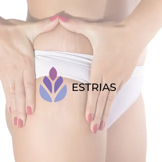 Estrias